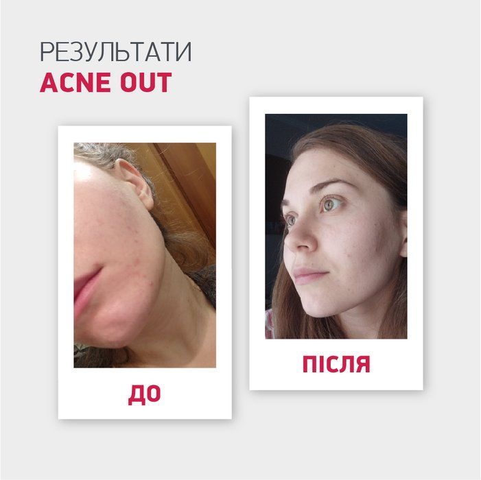 *Уцінка*_МАТУЮЧИЙ ТОНІК ACNE OUT / ДЛЯ ЖИРНОЇ ШКІРИ ТА ПРИ ЛЕГКИХ ФОРМАХ АКНЕ 60 мл
