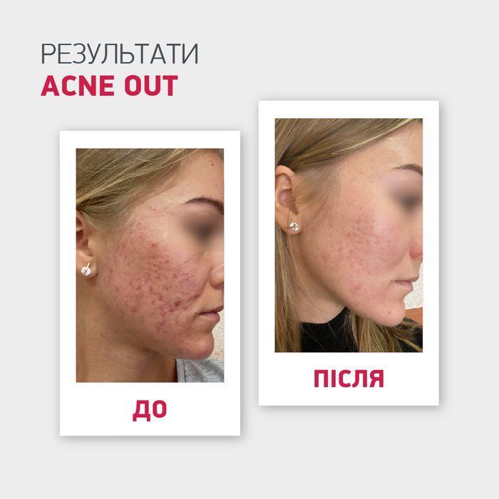 *УЦІНКА*_ВІДНОВЛЮВАЛЬНИЙ КРЕМ З SPF 30 ACNE OUT / ДЛЯ ШКІРИ З ВИДИМИМИ ДЕФЕКТАМИ ТА ПЛЯМАМИ ПОСТАКНЕ 30 мл