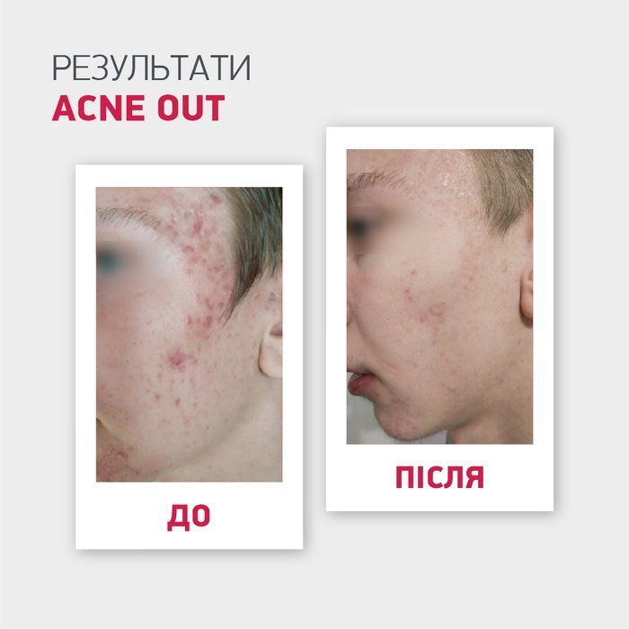 copy_AKTYWNY LOTION ACNE OUT / DO SK&Oacute;RY PROBLEMATYCZNEJ Z ZAPALNYMI FORMAMI TRĄDZIKU / MIEJSCOWA APLIKACJA