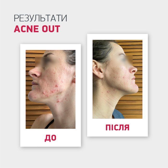 copy_AKTYWNY LOTION ACNE OUT / DO SK&Oacute;RY PROBLEMATYCZNEJ Z ZAPALNYMI FORMAMI TRĄDZIKU / MIEJSCOWA APLIKACJA