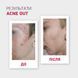 copy_AKTYWNY LOTION ACNE OUT / DO SK&Oacute;RY PROBLEMATYCZNEJ Z ZAPALNYMI FORMAMI TRĄDZIKU / MIEJSCOWA APLIKACJA