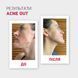copy_AKTYWNY LOTION ACNE OUT / DO SK&Oacute;RY PROBLEMATYCZNEJ Z ZAPALNYMI FORMAMI TRĄDZIKU / MIEJSCOWA APLIKACJA