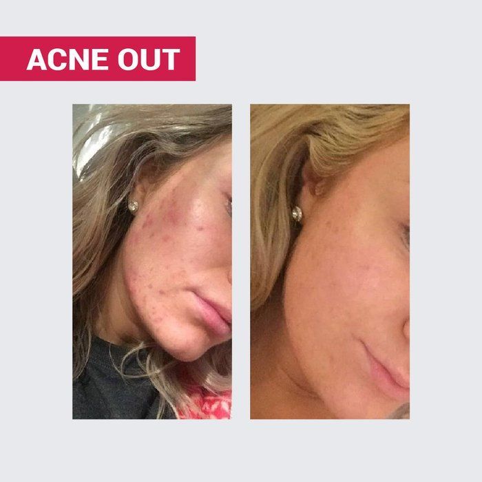 copy_NATURALNE MYDŁO ACNE OUT / DO SK&Oacute;RY TŁUSTEJ I PROBLEMATYCZNEJ TWARZY I CIAŁA