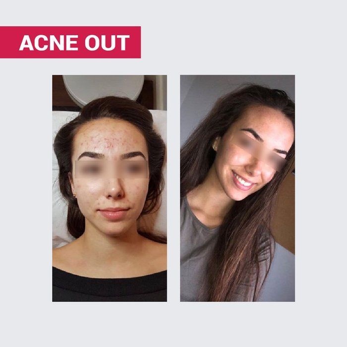*УЦІНКА*_АКТИВНИЙ КРЕМ ACNE OUT / ДЛЯ ПРОБЛЕМНОЇ ШКІРИ З ВУГРАМИ ТА КОМЕДОНАМИ / ЛОКАЛЬНОГО НАНЕСЕННЯ 30 мл