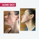 *УЦІНКА*_АКТИВНИЙ КРЕМ ACNE OUT / ДЛЯ ПРОБЛЕМНОЇ ШКІРИ З ВУГРАМИ ТА КОМЕДОНАМИ / ЛОКАЛЬНОГО НАНЕСЕННЯ 30 мл