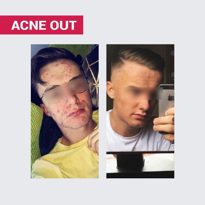 copy_ACNE OUT KOMPLEKS WITAMINOWY I MINERALNY / DO SK&Oacute;RY TŁUSTEJ I PROBLEMATYCZNEJ / W KAPSUŁKACH
